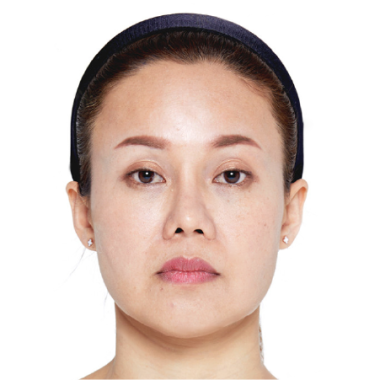 Trước khi cấy mỡ