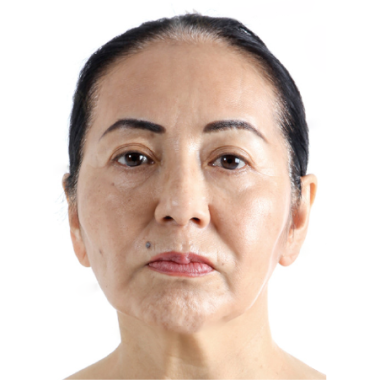 Trước khi cấy mỡ