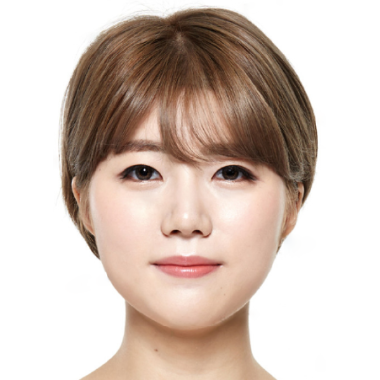 Sau khi cấy mỡ