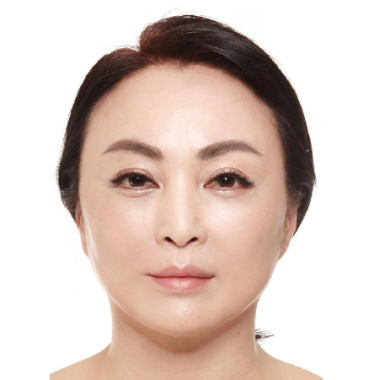 Sau khi cấy mỡ
