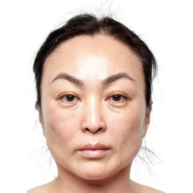 Trước khi cấy mỡ