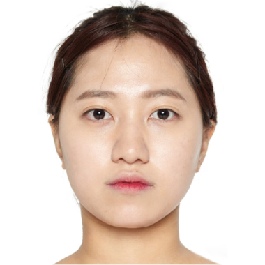 Trước khi cấy mỡ