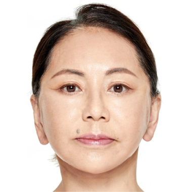 Sau khi cấy mỡ