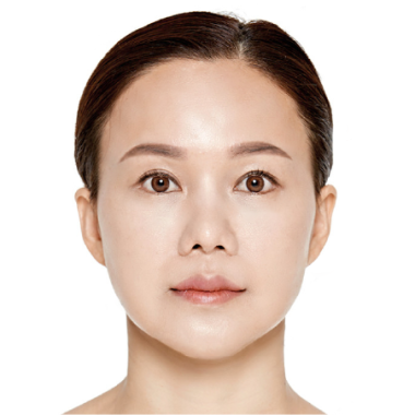 Sau khi cấy mỡ