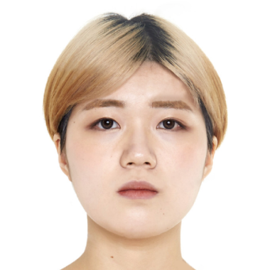 Trước khi cấy mỡ