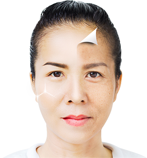CẤY MỠ NANO TRẺ HÓA LÀ GÌ?